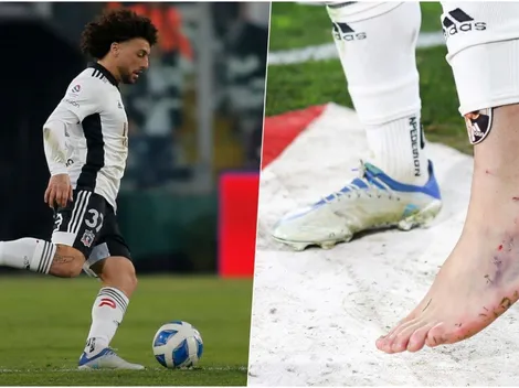 Así queda el tobillo de Maxi Falcón tras el planchazo de Cris Martínez