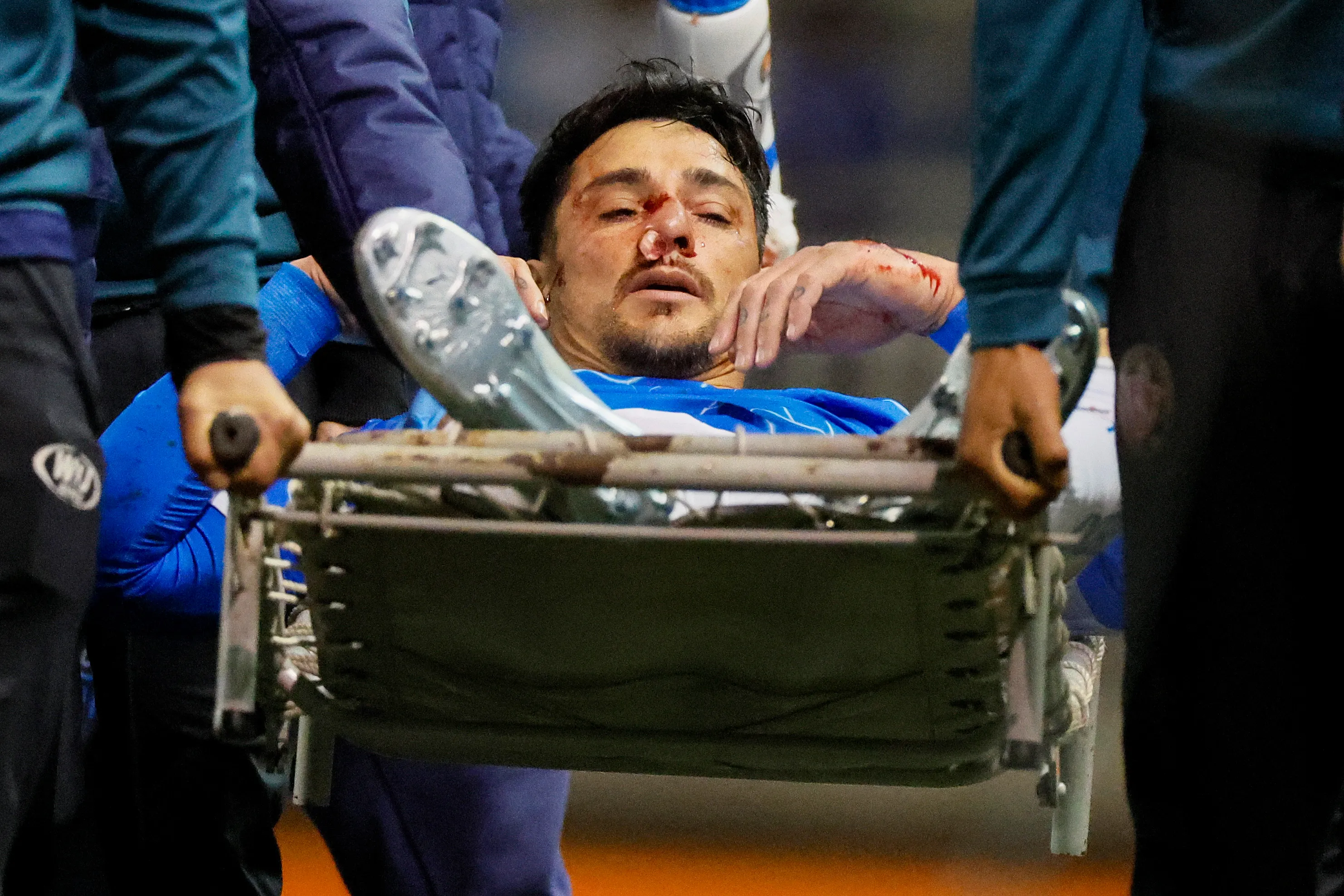 Fernando Zampedri sufrió una fractura nasal en el partido ante Deportes Limache del pasado sábado. 